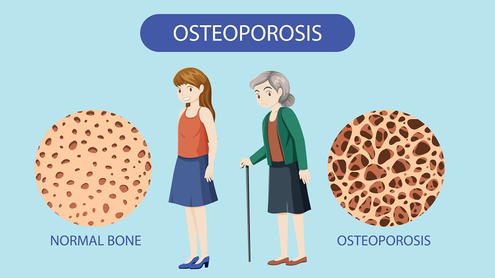 Illustration comparing normal bone and osteoporotic bone with a young healthy woman and an older woman with osteoporosis using a cane.