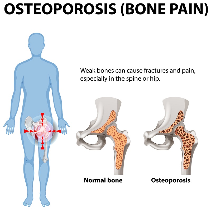 Illustration showing the comparison between normal bone and osteoporotic bone, highlighting bone loss and hip pain commonly associated with osteoporosis.