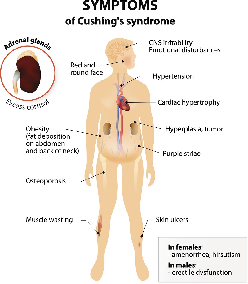 Medical illustration showing the symptoms of Cushing’s syndrome, including obesity, round face, purple striae, muscle wasting, skin ulcers, osteoporosis, hypertension, and emotional disturbances.